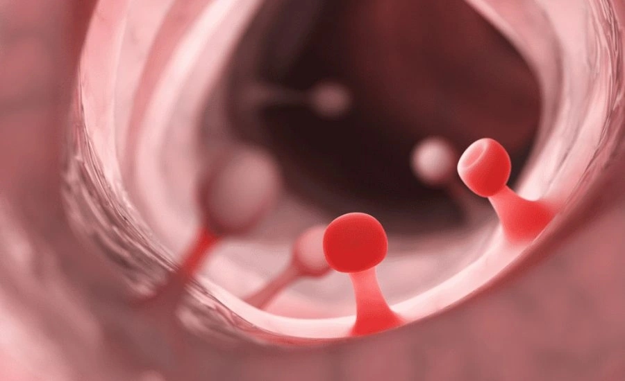 Полипы в матке