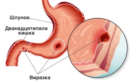 Виразка дванадцятипалої кишки: як розпізнати симптоми і ефективно лікувати