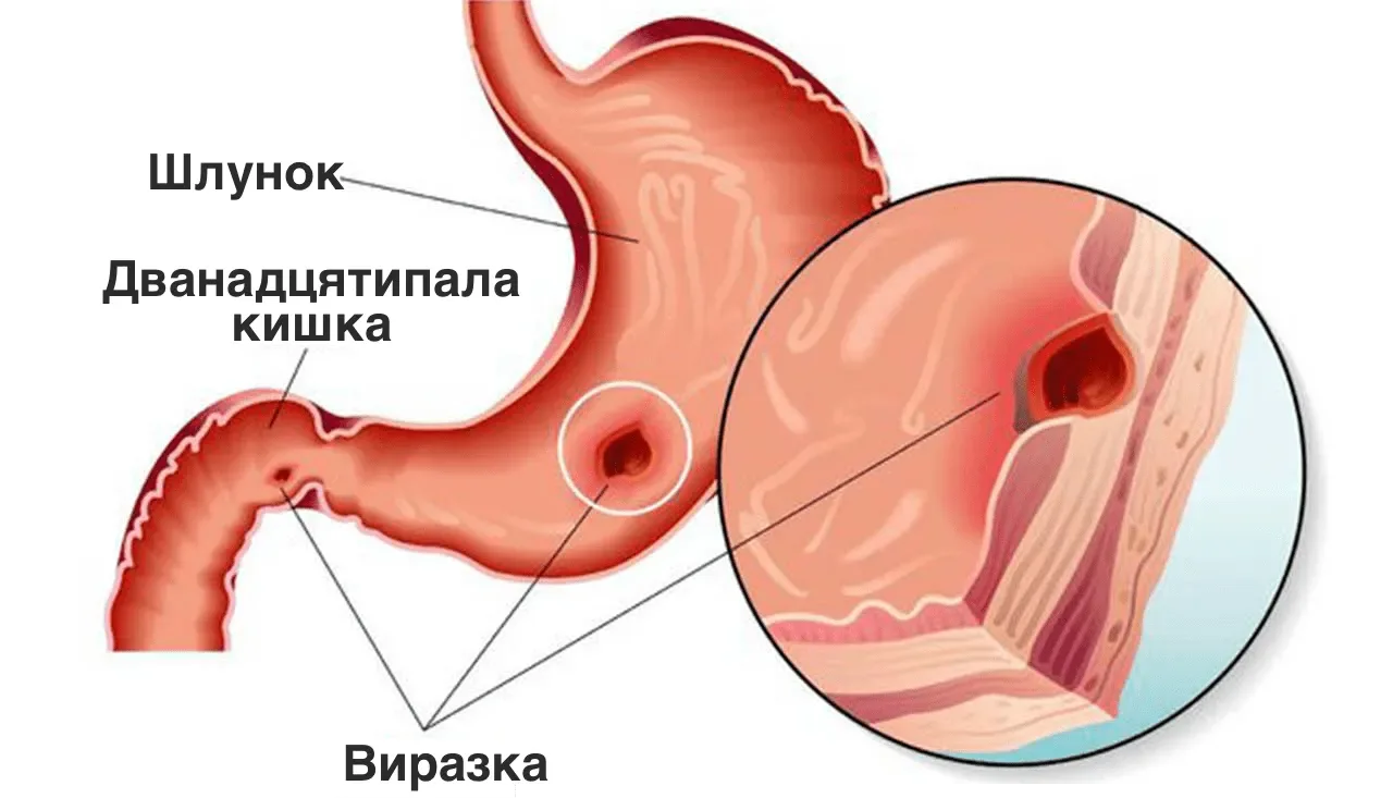 Виразка дванадцятипалої кишки: як розпізнати симптоми і ефективно лікувати